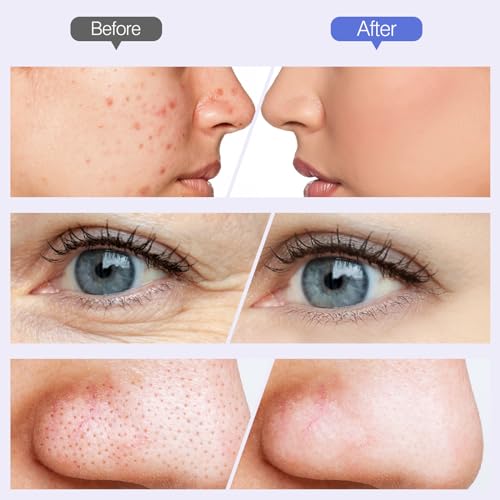 Diamond Micro-dermabrasion Machine G3715
